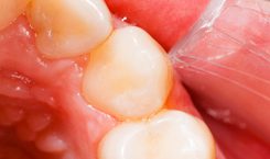 lagning_fyllning lagning_fyllning