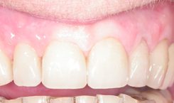 porslinskrona_bro porslinskrona_bro