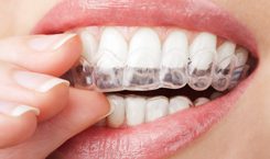 tandblekning tandblekning